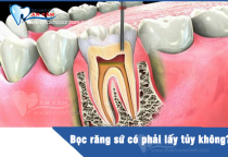 BỌC RĂNG SỨ CÓ CẦN LẤY TỦY KHÔNG? BỌC RĂNG SỨ CÓ CẦN LẤY TỦY KHÔNG?