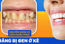RĂNG BỊ ĐEN Ở KẼ: NGUYÊN NHÂN VÀ CÁCH KHẮC PHỤC RĂNG BỊ ĐEN Ở KẼ: NGUYÊN NHÂN VÀ CÁCH KHẮC PHỤC