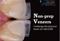NHA KHOA BẢO TỒN - MẶT DÁN SỨ NON-PREP VENEER NHA KHOA BẢO TỒN - MẶT DÁN SỨ NON-PREP VENEER