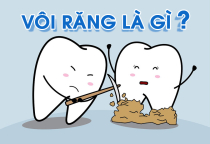 NHA KHOA BẢO TỒN - VÔI RĂNG LÀ GÌ?  NHA KHOA BẢO TỒN - VÔI RĂNG LÀ GÌ?