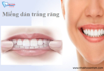 CÓ NÊN DÙNG MIẾNG DÁN TRẮNG RĂNG KHÔNG? CÓ NÊN DÙNG MIẾNG DÁN TRẮNG RĂNG KHÔNG?