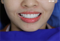 SO SÁNH RĂNG SỨ CERCON XT VÀ CERCON HT SO SÁNH RĂNG SỨ CERCON XT VÀ CERCON HT