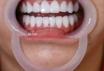 VENEER EMAX – TRƯỜNG HỢP NÊN DÁN SỨ EMAX VENEER EMAX – TRƯỜNG HỢP NÊN DÁN SỨ EMAX