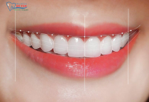 THẾ NÀO LÀ HÀM RĂNG ĐẸP CHUẨN Y KHOA? THẾ NÀO LÀ HÀM RĂNG ĐẸP CHUẨN Y KHOA?