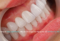 NHỮNG TRƯỜNG HỢP KHÔNG NÊN BỌC SỨ THẨM MỸ NHỮNG TRƯỜNG HỢP KHÔNG NÊN BỌC SỨ THẨM MỸ