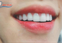 RĂNG SỨ ZIRCONIA CÓ TỐT KHÔNG? RĂNG SỨ ZIRCONIA CÓ TỐT KHÔNG?