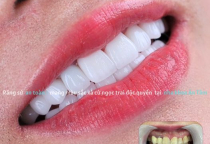 NHA KHOA BẢO TỒN - BỌC RĂNG SỨ BAO LÂU THÌ PHẢI LÀM LẠI? NHA KHOA BẢO TỒN - BỌC RĂNG SỨ BAO LÂU THÌ PHẢI LÀM LẠI?