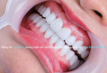 RĂNG TOÀN SỨ CAO CÂP LAVA PLUS