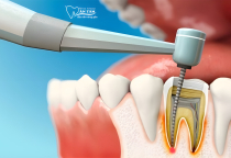 NHA KHOA BẢO TỒN - QUY TRÌNH LẤY TỦY RĂNG NHƯ THẾ NÀO? MẤT BAO LÂU? NHA KHOA BẢO TỒN - QUY TRÌNH LẤY TỦY RĂNG NHƯ THẾ NÀO? MẤT BAO LÂU?
