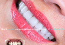 NHA KHOA BẢO TỒN - RĂNG SỨ BỊ MẺ CÓ TRÁM ĐƯỢC KHÔNG?