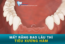 MẤT RĂNG BAO LÂU THÌ BỊ TIÊU XƯƠNG HÀM. MẤT RĂNG BAO LÂU THÌ BỊ TIÊU XƯƠNG HÀM.