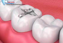 RĂNG HÀM BỊ MẺ KHẮC PHỤC NHƯ THẾ NÀO? RĂNG HÀM BỊ MẺ KHẮC PHỤC NHƯ THẾ NÀO?