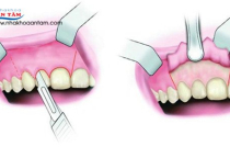 PHẪU THUẬT CẮT CHÓP RĂNG PHẪU THUẬT CẮT CHÓP RĂNG
