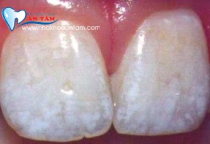 BỆNH THIỂU SẢN MEN RĂNG LÀ GÌ? NGUYÊN NHÂN DO ĐÂU VÀ CÁCH KHẮC PHỤC? BỆNH THIỂU SẢN MEN RĂNG LÀ GÌ? NGUYÊN NHÂN DO ĐÂU VÀ CÁCH KHẮC PHỤC?