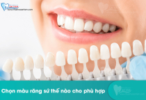 CÁCH CHỌN MÀU RĂNG SỨ THẾ NÀO PHÙ HỢP. CÁCH CHỌN MÀU RĂNG SỨ THẾ NÀO PHÙ HỢP.
