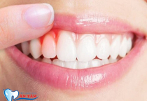 NGUYÊN NHÂN CHẢY MÁU NƯỚU RĂNG VÀ CÁCH ĐIỀU TRỊ NGUYÊN NHÂN CHẢY MÁU NƯỚU RĂNG VÀ CÁCH ĐIỀU TRỊ