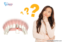 KHI NÀO NÊN BỌC RĂNG SỨ KHI NÀO NÊN BỌC RĂNG SỨ