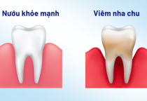 NHA KHOA BẢO TỒN: VIÊM NHA CHU – KẺ THÙ THẦM LẶNG! NHA KHOA BẢO TỒN: VIÊM NHA CHU – KẺ THÙ THẦM LẶNG!