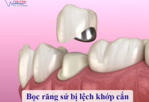 NHA KHOA BẢO TỒN - BỌC RĂNG SỨ BỊ LỆCH KHỚP CẮN: NGUYÊN NHÂN VÀ CÁCH KHẮC PHỤC NHA KHOA BẢO TỒN - BỌC RĂNG SỨ BỊ LỆCH KHỚP CẮN: NGUYÊN NHÂN VÀ CÁCH KHẮC PHỤC