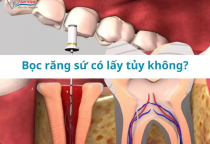 CÓ CẦN PHẢI LẤY TỦY TRƯỚC KHI BỌC SỨ KHÔNG? CÓ CẦN PHẢI LẤY TỦY TRƯỚC KHI BỌC SỨ KHÔNG?