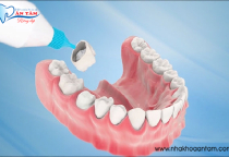 NHỮNG TRƯỜNG HỢP NÊN BỌC RĂNG SỨ HÀM DƯỚI? NHỮNG TRƯỜNG HỢP NÊN BỌC RĂNG SỨ HÀM DƯỚI?