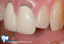 THÁO RĂNG SỨ CÓ ĐAU KHÔNG? THÁO RĂNG SỨ CÓ ĐAU KHÔNG?