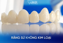 NHA KHOA BẢO TỒN - RĂNG SỨ KHÔNG KIM LOẠI LÀ GÌ? NHA KHOA BẢO TỒN - RĂNG SỨ KHÔNG KIM LOẠI LÀ GÌ?