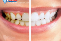 TÁC HẠI CỦA VÔI RĂNG TÁC HẠI CỦA VÔI RĂNG