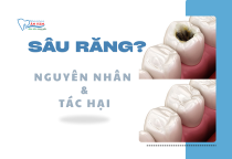 NHA KHOA BẢO TỒN - NGUYÊN NHÂN VÀ TÁC HẠI CỦA SÂU RĂNG? NHA KHOA BẢO TỒN - NGUYÊN NHÂN VÀ TÁC HẠI CỦA SÂU RĂNG?