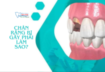 NHA KHOA BẢO TỒN - RĂNG BỊ GÃY CÒN CHÂN RĂNG PHẢI LÀM SAO? NHA KHOA BẢO TỒN - RĂNG BỊ GÃY CÒN CHÂN RĂNG PHẢI LÀM SAO?