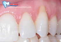 NGUYÊN NHÂN GÂY TỤT LỢI VÀ CÁCH ĐIỀU TRỊ HIỆU QUẢ NGUYÊN NHÂN GÂY TỤT LỢI VÀ CÁCH ĐIỀU TRỊ HIỆU QUẢ