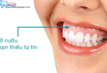 CƯỜI HỞ LỢI LÀ GÌ? ĐIỀU TRỊ HỞ LỢI NHƯ THẾ NÀO? CƯỜI HỞ LỢI LÀ GÌ? ĐIỀU TRỊ HỞ LỢI NHƯ THẾ NÀO?