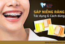 SỬ DỤNG SÁP CHỈNH NHA HIỆU QUẢ SỬ DỤNG SÁP CHỈNH NHA HIỆU QUẢ
