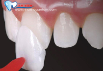 DÁN SỨ VENEER CÓ BỀN KHÔNG? DÁN SỨ VENEER CÓ BỀN KHÔNG?