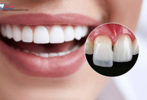 HẬU QUẢ CỦA VIỆC DÁN VENEER SAI KỸ THUẬT. HẬU QUẢ CỦA VIỆC DÁN VENEER SAI KỸ THUẬT.