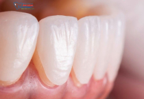 NHA KHOA BẢO TỒN - ƯU VÀ NHƯỢC ĐIỂM CỦA DÁN RĂNG SỨ VENEER NHA KHOA BẢO TỒN - ƯU VÀ NHƯỢC ĐIỂM CỦA DÁN RĂNG SỨ VENEER