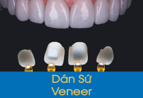 ĐỘ BỀN CỦA MẶT DÁN SỨ ĐƯỢC BAO LÂU? ĐỘ BỀN CỦA MẶT DÁN SỨ ĐƯỢC BAO LÂU?