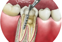 NHA KHOA BẢO TỒN - CHỮA TỦY RĂNG SỐ 7 CÓ PHỨC TẠP KHÔNG?