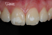 NHA KHOA BẢO TỒN - VÌ SAO RĂNG CÓ ĐỐM TRẮNG? CÁCH KHẮC PHỤC HIỆU QUẢ NHA KHOA BẢO TỒN - VÌ SAO RĂNG CÓ ĐỐM TRẮNG? CÁCH KHẮC PHỤC HIỆU QUẢ