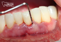NHA KHOA BẢO TỒN - VIÊM NHA CHU CÓ NGUY HIỂM KHÔNG? NHA KHOA BẢO TỒN - VIÊM NHA CHU CÓ NGUY HIỂM KHÔNG?