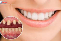 ĐỘ TUỔI NÀO PHÙ HỢP ĐỂ BỌC RĂNG SỨ ĐỘ TUỔI NÀO PHÙ HỢP ĐỂ BỌC RĂNG SỨ