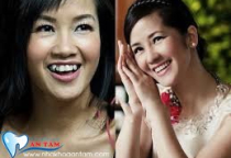CÓ NÊN NHỔ RĂNG KHỂNH KHÔNG? CÓ NÊN NHỔ RĂNG KHỂNH KHÔNG?