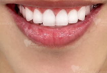 BỌC RĂNG SỨ Ở ĐÂU TỐT NHẤT BỌC RĂNG SỨ Ở ĐÂU TỐT NHẤT