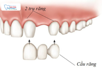 CÓ NÊN LÀM CẦU RĂNG SỨ CHO RĂNG CỬA KHÔNG? CÓ NÊN LÀM CẦU RĂNG SỨ CHO RĂNG CỬA KHÔNG?