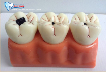 RĂNG SÂU CÓ BỌC SỨ ĐƯỢC KHÔNG? RĂNG SÂU CÓ BỌC SỨ ĐƯỢC KHÔNG?