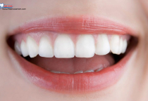 LỰA  CHỌN VẬT LIỆU SỨ CHO PHÙ HỢP BỆNH NHÂN LỰA  CHỌN VẬT LIỆU SỨ CHO PHÙ HỢP BỆNH NHÂN
