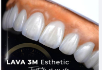 RĂNG SỨ LAVA ESTHETIC LÀ GÌ? RĂNG SỨ LAVA ESTHETIC LÀ GÌ?