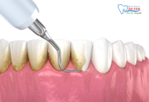 LỢI ÍCH CỦA VIỆC LẤY CAO RĂNG LỢI ÍCH CỦA VIỆC LẤY CAO RĂNG
