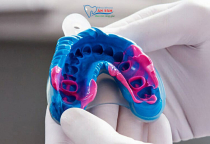 LẤY DẤU RĂNG ĐỂ LÀM GÌ? CÁCH LẤY DẤU RĂNG NHA KHOA ĐÚNG CHUẨN? LẤY DẤU RĂNG ĐỂ LÀM GÌ? CÁCH LẤY DẤU RĂNG NHA KHOA ĐÚNG CHUẨN?