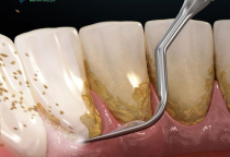NHA KHOA BẢO TỒN - CÓ NÊN LẤY VÔI RĂNG THƯỜNG XUYÊN KHÔNG? NHA KHOA BẢO TỒN - CÓ NÊN LẤY VÔI RĂNG THƯỜNG XUYÊN KHÔNG?